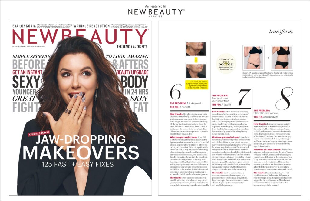 Dr. Rucker’s popular Cheek & Neck Lift procedure is one of NewBeauty’s jaw-dropping makeovers!