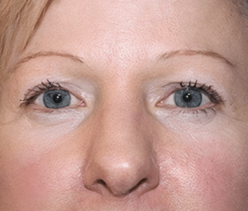 Before Blepharoplasty photo