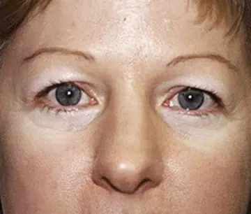 Before Blepharoplasty photo