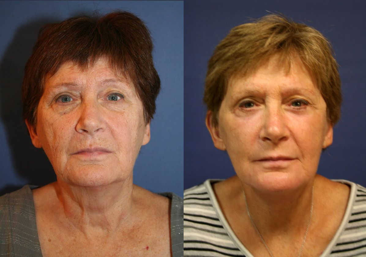 Facelift before and after gallery. Eau Claire, WI | Dr. Joseph Rucker