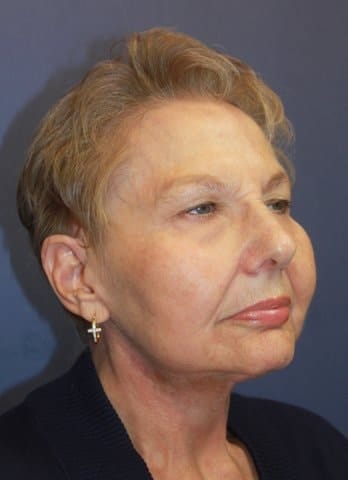 4 months after Cheek and Necklift ( 2 1/2 hr procedure, done in office operatory)