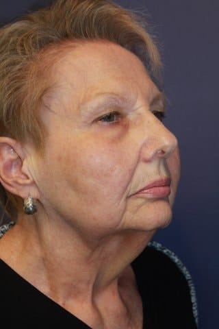 Facelift before and after gallery. Eau Claire, WI | Dr. Joseph Rucker