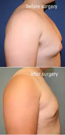 Gynecomastia (male breast reduction) procedure