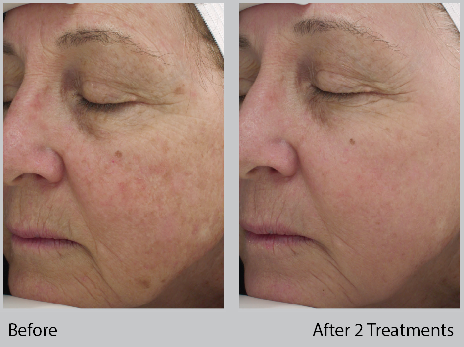 Halo Treatment Before and After gallery. Eau Claire, WI | Dr. Joseph Rucker