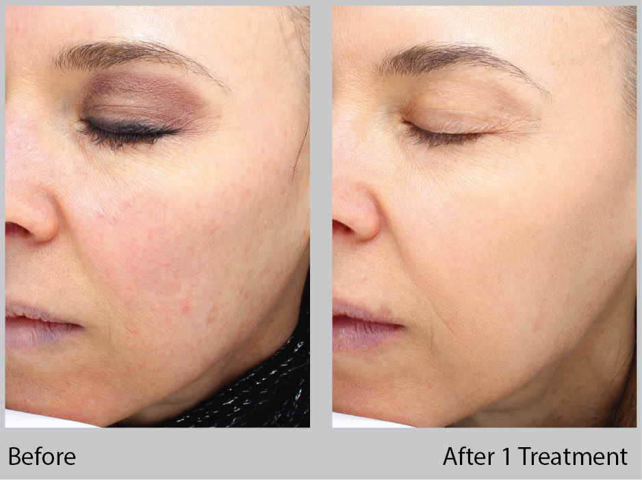 Halo Treatment Before and After gallery. Eau Claire, WI | Dr. Joseph Rucker