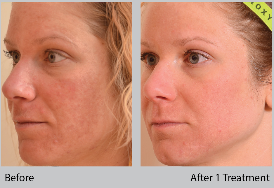 Halo Treatment Before and After Wisconsin 3