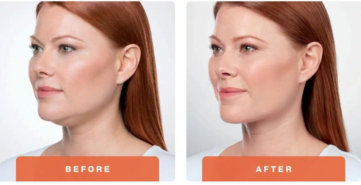 Kybella before and after photos. Non Invasive Treatment | Dr. Ember Ewings