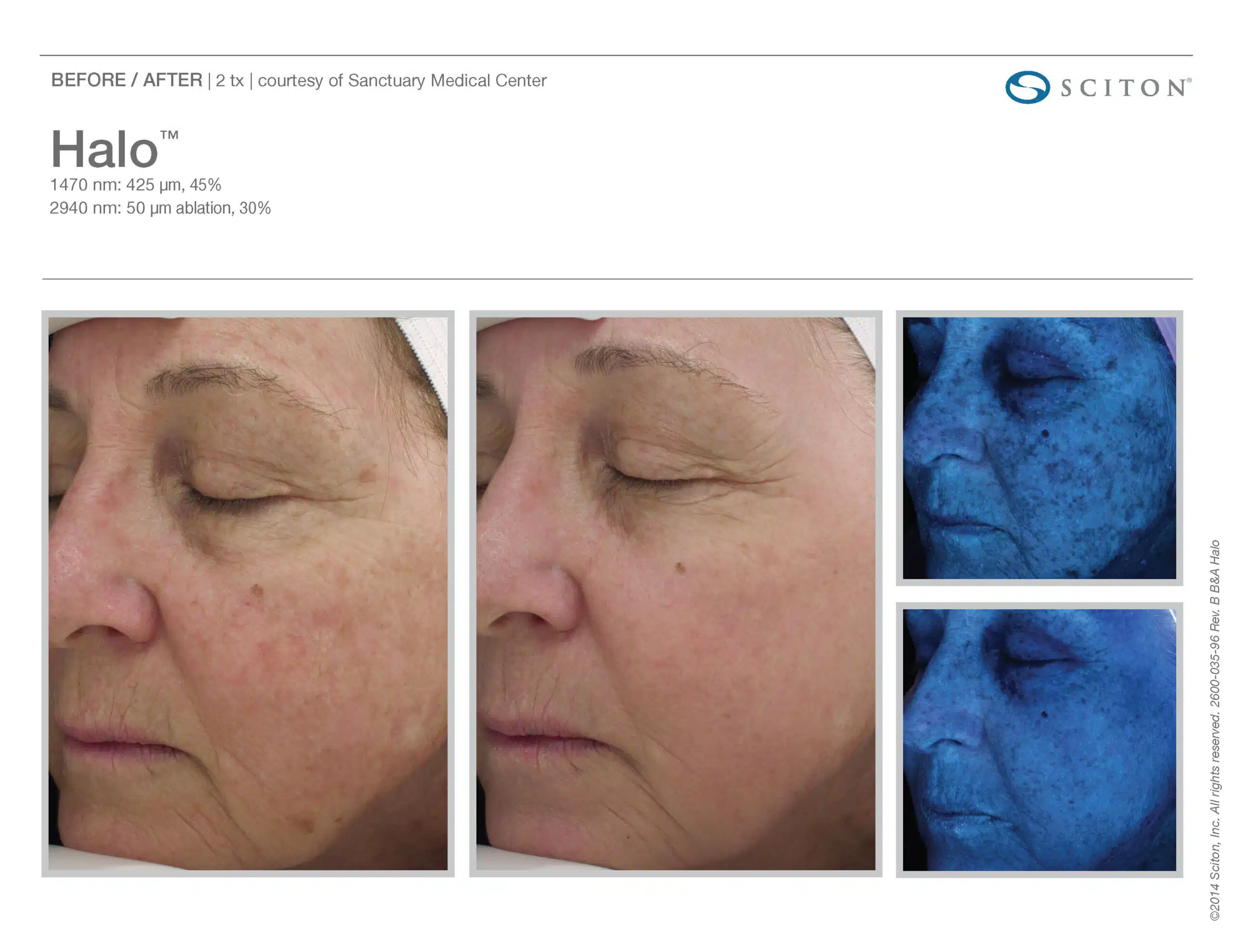 Non Invasive Treatments - Halo Fractional Laser at Plastic Surgery Clinicec of Eau Claire, Wisconsin | Dr. Ember Ewings  
