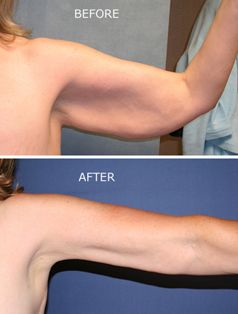 Brachioplasty (arm lift) procedure before and after photos