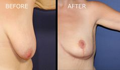 Breast Left before and after