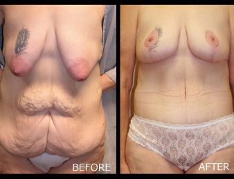 Breast Lift, Tummy Tuck, Arm Lift Before and After