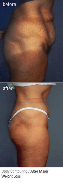 Body Contouring after Weight Loss - Before and After pictures. Plastic Surgery Clinicec of Eau Claire, Wisconsin | Dr. Joseph Rucker