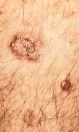 Fig 2: Squamous Skin Cancer