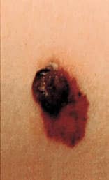 Fig 3: Malignant Melanoma