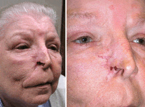 Post Nasal Cancer Excision