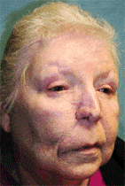 Nasal Reconstruction After Extensive Skin Cancer Removal