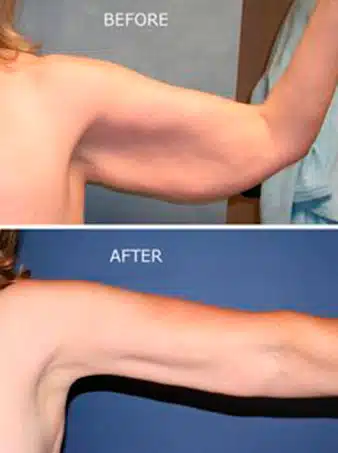 Brachioplasty (arm lift) procedure before and after photos