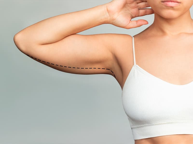 Say Goodbye to Flabby Arms with Arm Lift Surgery in Eau Claire, WI