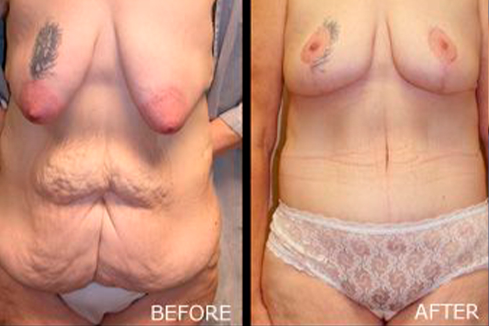 Breast Lift, Tummy Tuck, Arm Lift Before and After