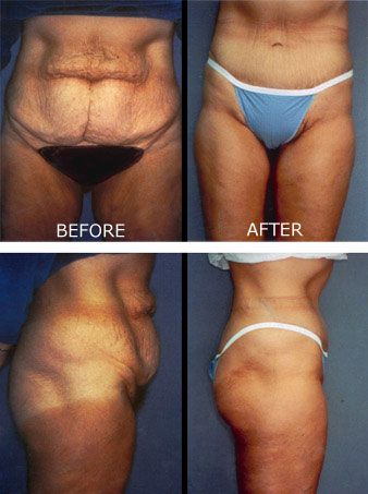 Abdominoplasty (Tummy Tuck/Panniculectomy) Before and After photos