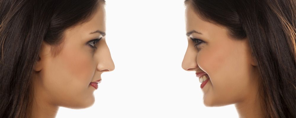 Eighty percent of the swelling will have subsided within 10 days. Rhinoplasty by Dr. Ember Ewings | Eau Claire, Wisconsin