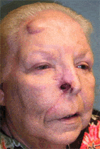 Nasal Reconstruction After Extensive Skin Cancer Removal