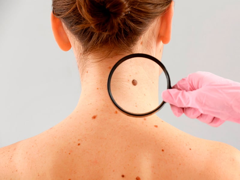 Skin cancer is the most common form of cancer in the United States. Skin Cancer treatment at Plastic Surgery Clinicec of Eau Claire, Wisconsin | Dr. Ember Ewings  