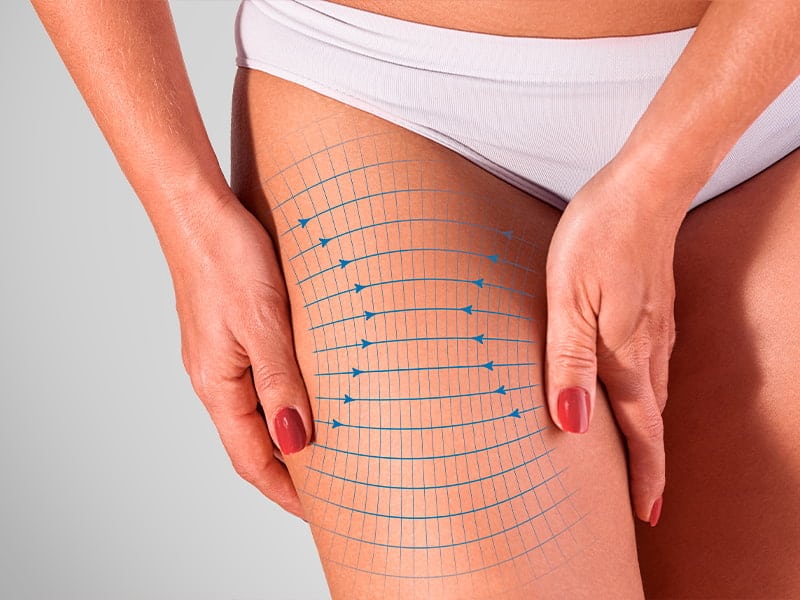 Dr. Ember Ewings of the Plastic Surgery Clinic of Eau Claire, WI is proud to offer patients thigh lift surgery.