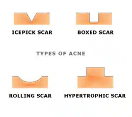 Most people have acne scars that are mild, although some individuals have scars that look significant even to others. Eau Claire, WI | Dr. Ember Ewings