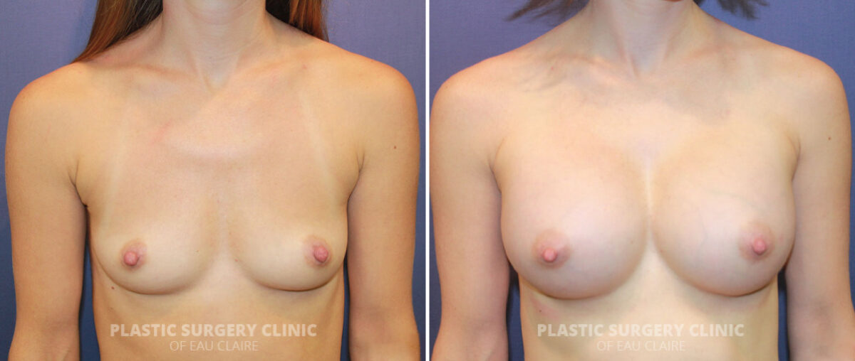 Breast Augmentation Before and After Photos in Eau Claire, Wisconsin, Patient 1281