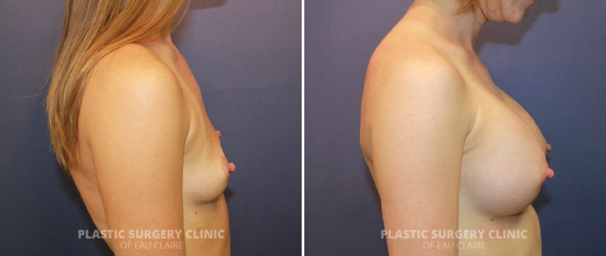 Breast Augmentation Before and After Photos in Eau Claire, Wisconsin, Patient 1281