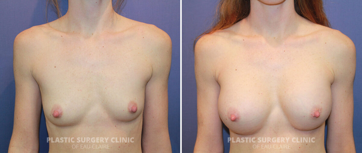 Breast Augmentation Before and After Photos in Eau Claire, Wisconsin, Patient 1294