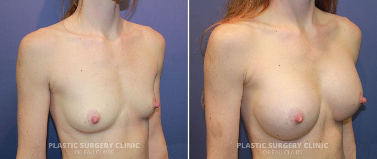 Breast Augmentation Before and After Photos in Eau Claire, Wisconsin, Patient 1294