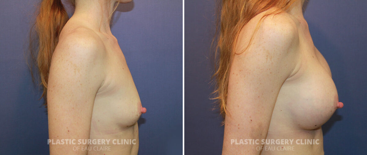 Breast Augmentation Before and After Photos in Eau Claire, Wisconsin, Patient 1294