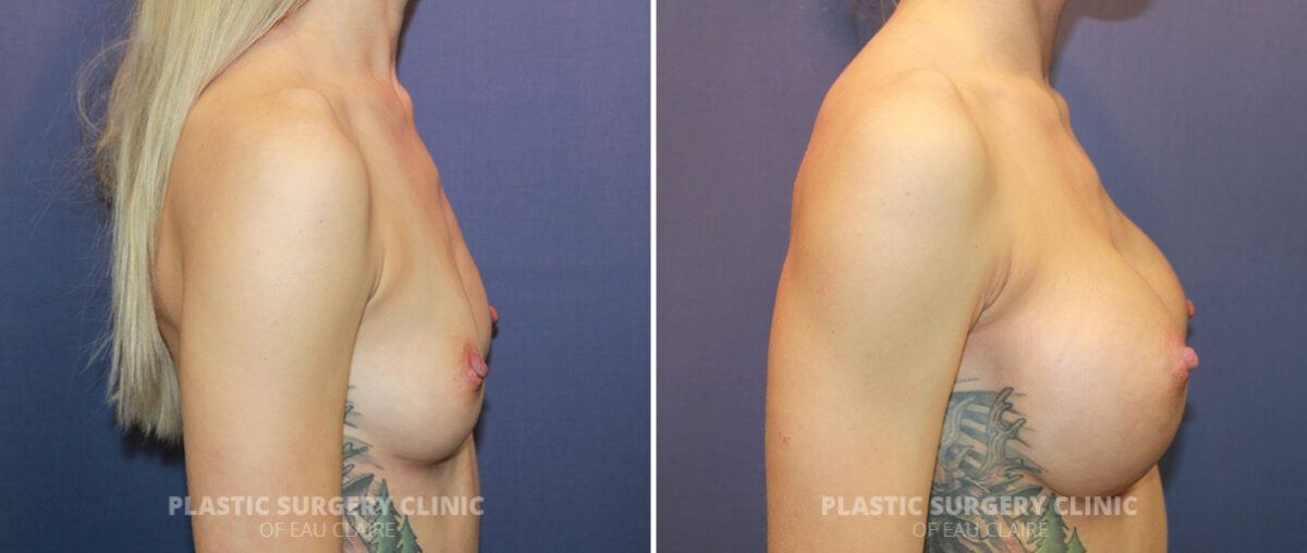 Breast Augmentation Before and After Photos in Eau Claire, Wisconsin, Patient 1320