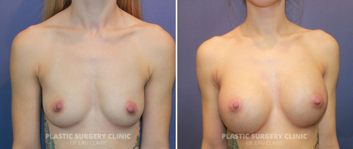 Breast Augmentation Before and After Photos in Eau Claire, Wisconsin, Patient 1320