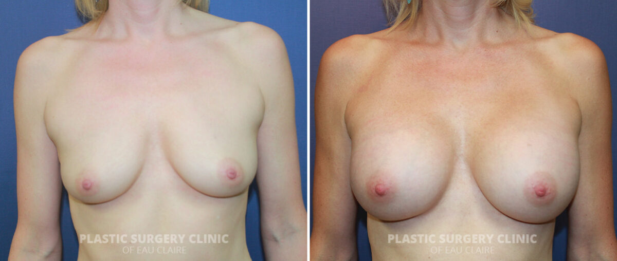 Breast Augmentation Before and After Photos in Eau Claire, Wisconsin, Patient 1447