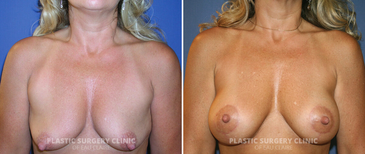 Breast Augmentation Before and After Photos in Eau Claire, Wisconsin, Patient 1461