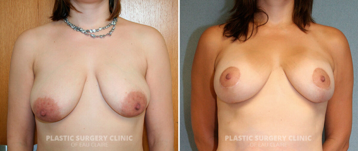 Breast Asymmetry Before and After Photos in Eau Claire, Wisconsin, Patient 55