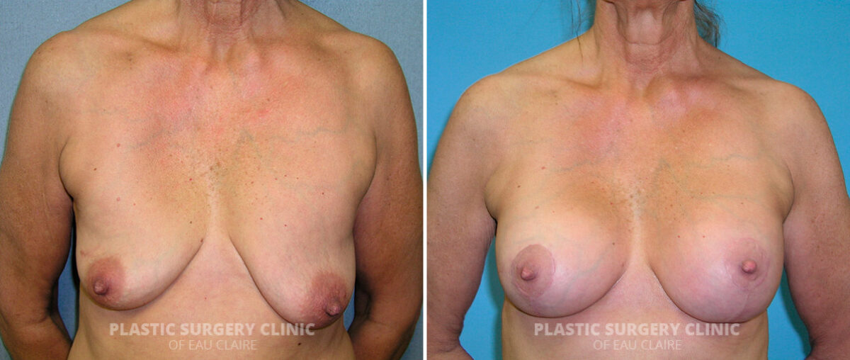 Breast Asymmetry Before and After Photos in Eau Claire, Wisconsin, Patient 66