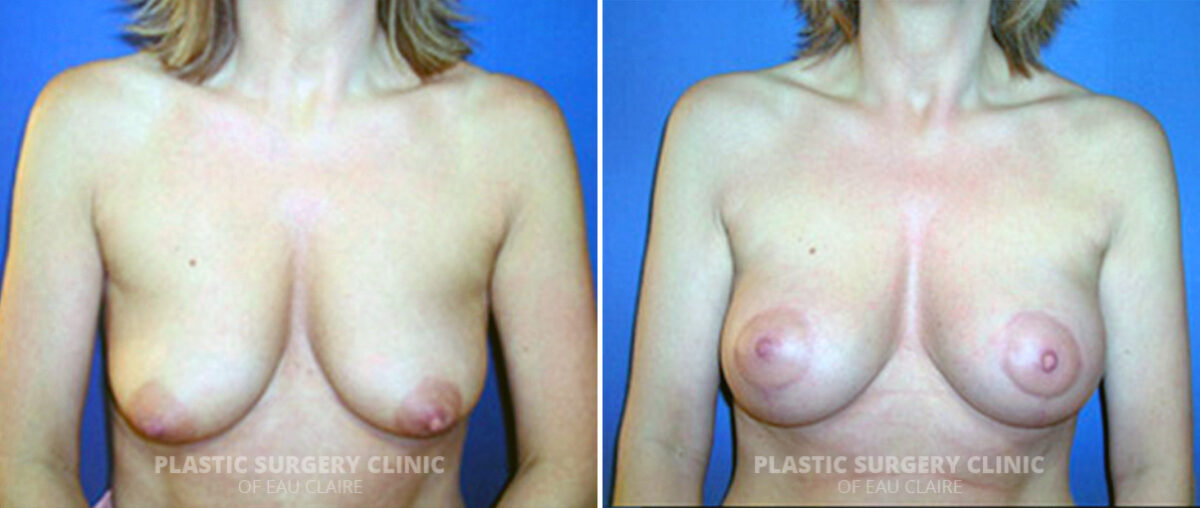 Breast Lift Before and After Photos in Eau Claire, Wisconsin, Patient 102