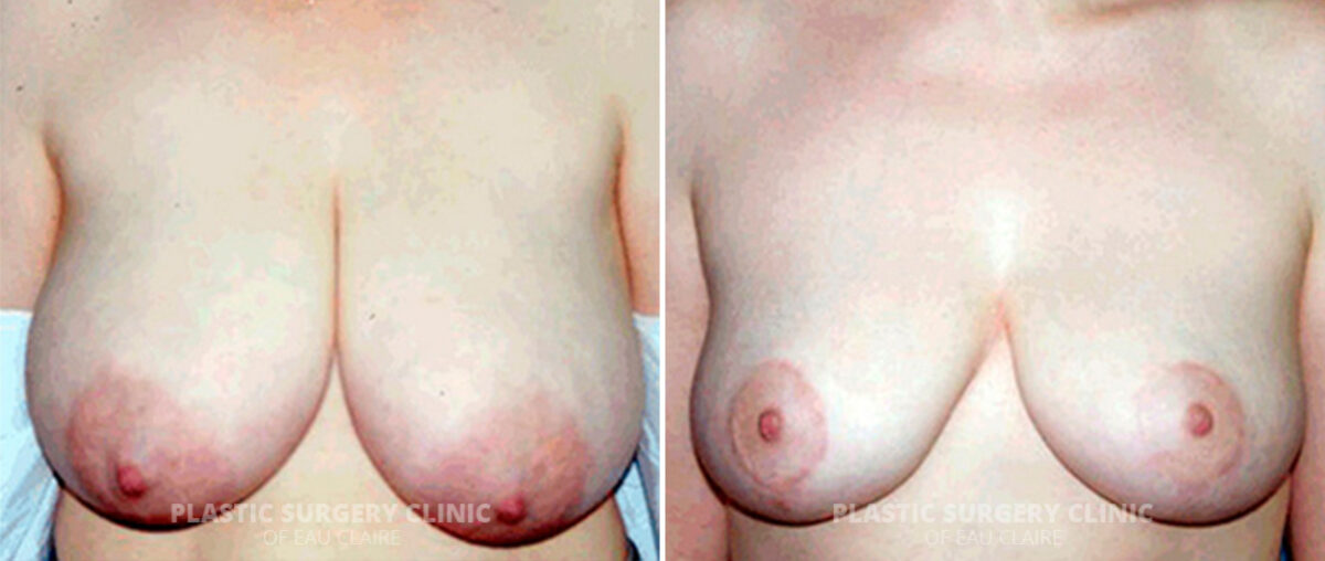 Breast Reduction Before and After Photos in Eau Claire, Wisconsin, Patient 106