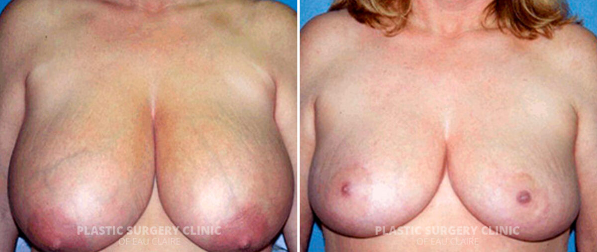 Breast Reduction Before and After Photos in Eau Claire, Wisconsin, Patient 118