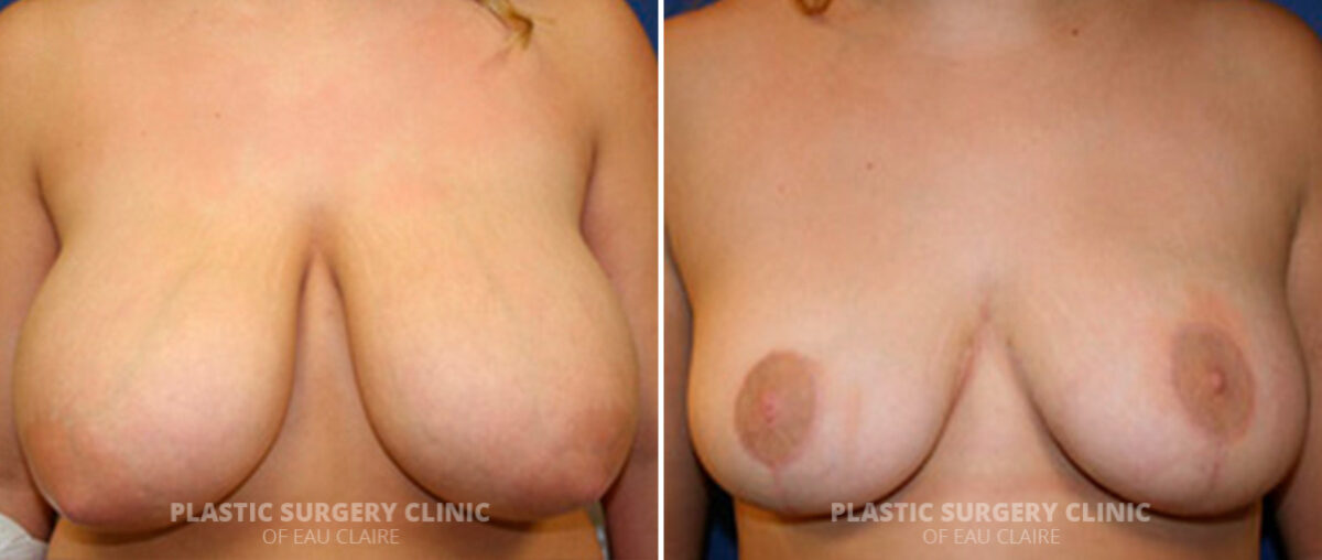 Breast Reduction Before and After Photos in Eau Claire, Wisconsin, Patient 122