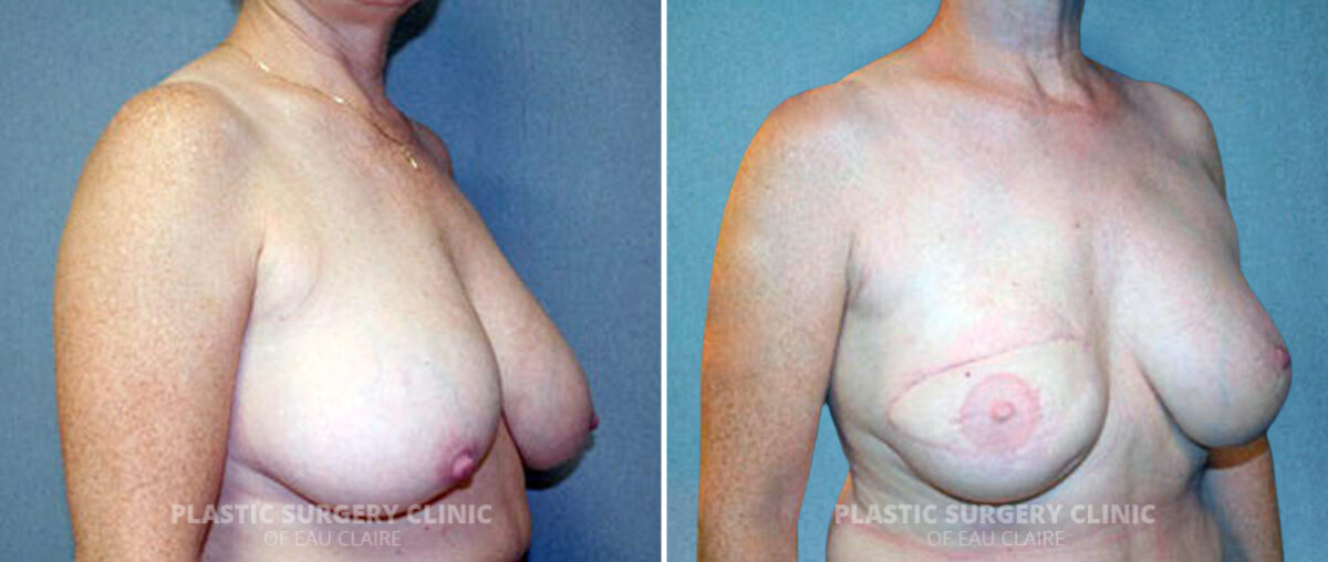 Breast Reconstruction Before and After Photos in Eau Claire, Wisconsin, Patient 126