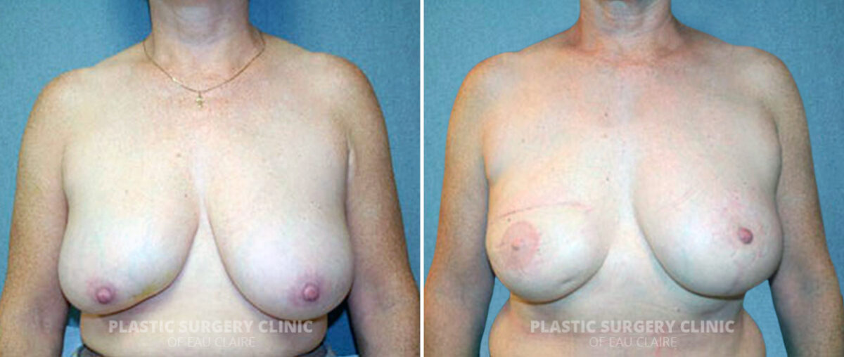 Breast Reconstruction Before and After Photos in Eau Claire, Wisconsin, Patient 126