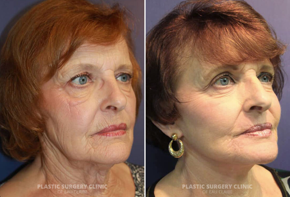 Facelift Before and After Photos in Eau Claire, Wisconsin, Patient 1299