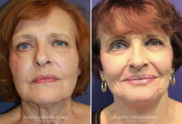 Facelift Before and After Photos in Eau Claire, Wisconsin, Patient 1299