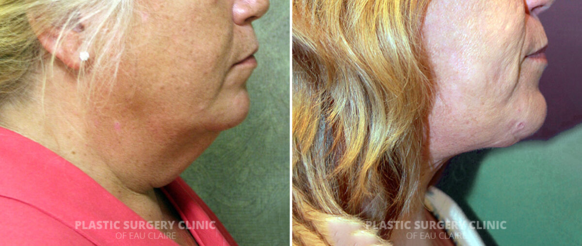 Neck Lift Before and After Photos in Eau Claire, Wisconsin, Patient 1306