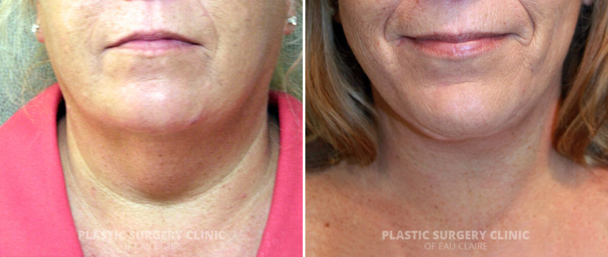 Neck Lift Before and After Photos in Eau Claire, Wisconsin, Patient 1306